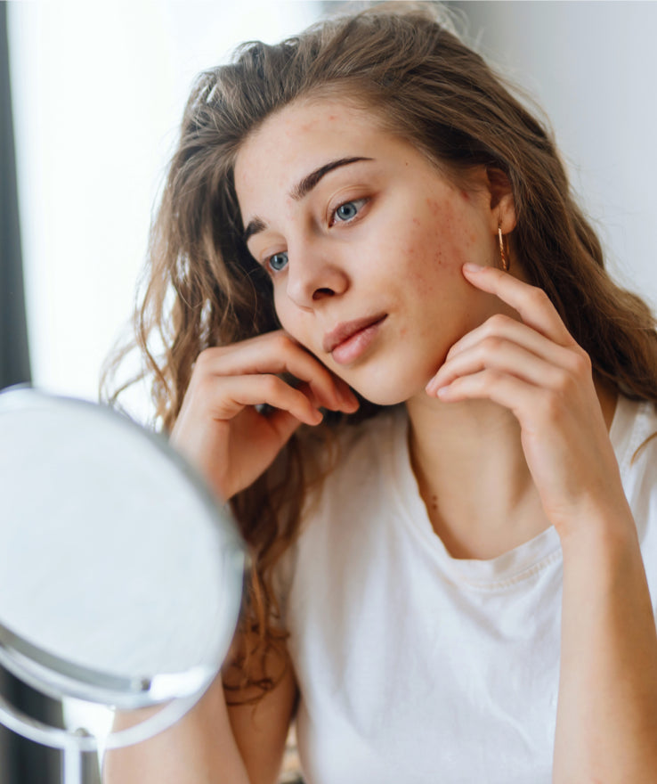 The Secrets to Flawless Skin: Effective Acne Solutions